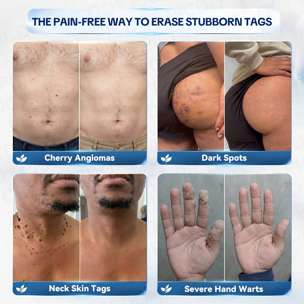 𝐏𝐢𝐜𝐝𝐨® 7-𝐃𝐚𝐲 𝐒𝐤𝐢𝐧 𝐓𝐚𝐠 & 𝐒𝐩𝐨𝐭 𝐄𝐫𝐚𝐬𝐞𝐫 𝐂𝐫𝐞𝐚𝐦 (Zero Pain, Zero 𝐒𝐜𝐚𝐫𝐬 Formula) 🌺