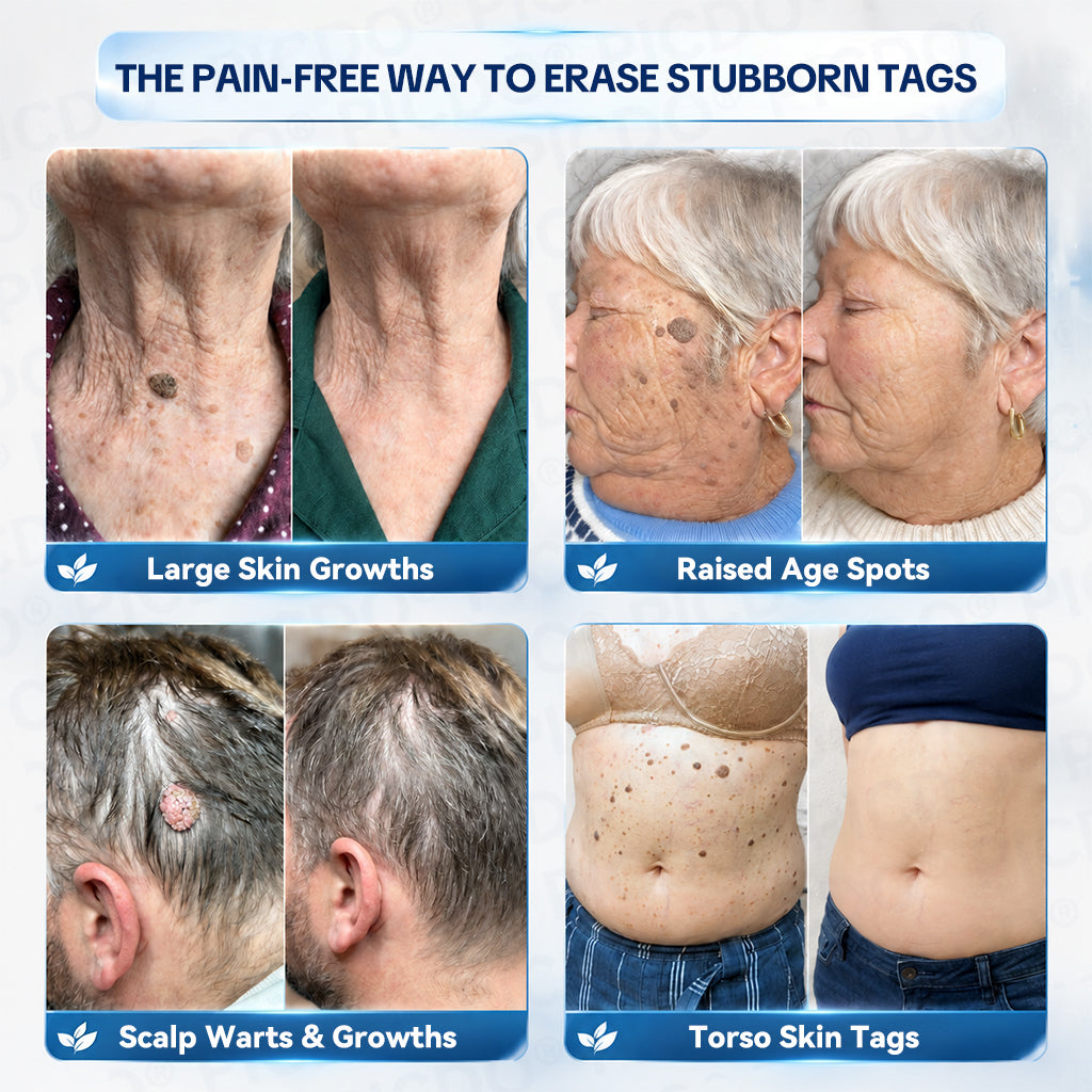 𝐏𝐢𝐜𝐝𝐨® 7-𝐃𝐚𝐲 𝐒𝐤𝐢𝐧 𝐓𝐚𝐠 & 𝐒𝐩𝐨𝐭 𝐄𝐫𝐚𝐬𝐞𝐫 𝐂𝐫𝐞𝐚𝐦 (Zero Pain, Zero 𝐒𝐜𝐚𝐫𝐬 Formula) 🌺