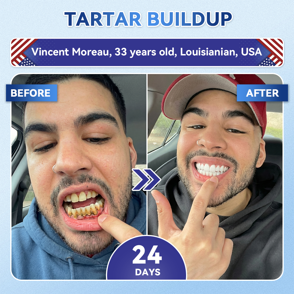 🦷𝐆𝐥𝐢𝐦𝐦𝐞𝐫𝐥𝐲® 𝐓𝐢𝐝𝐞𝐠𝐥𝐮𝐬𝐢𝐛 𝐓𝐨𝐨𝐭𝐡 & 𝐆𝐮𝐦 𝐑𝐞𝐩𝐚𝐢𝐫 𝐌𝐢𝐜𝐫𝐨𝐧𝐞𝐞𝐝𝐥𝐞 𝐏𝐚𝐭𝐜𝐡  |💝 𝐀𝐝𝐯𝐚𝐧𝐜𝐞𝐝 𝐒𝐭𝐞𝐦-𝐂𝐞𝐥𝐥 𝐀𝐜𝐭𝐢𝐯𝐚𝐭𝐢𝐨𝐧 𝐓𝐞𝐞𝐭𝐡 𝐒𝐭𝐫𝐢𝐩𝐬(🦷𝐑𝐞𝐛𝐮𝐢𝐥𝐝 𝐄𝐧𝐚𝐦𝐞𝐥 & 𝐃𝐞𝐧𝐭𝐢𝐧 • 𝐒𝐭𝐫𝐞𝐧𝐠𝐭𝐡𝐞𝐧 𝐆𝐮𝐦𝐬 • 𝐄𝐫𝐚𝐝𝐢𝐜𝐚𝐭𝐞 𝐓𝐚𝐫𝐭𝐚𝐫 & 𝐎𝐝𝐨𝐫 • 𝐒𝐭𝐨𝐩 𝐓𝐨𝐨𝐭𝐡 𝐒𝐞𝐧𝐬𝐢𝐭𝐢𝐯𝐢𝐭𝐲)