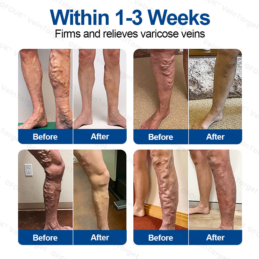 ✅𝐅𝐥𝐨𝐫𝐢𝐬𝐦𝐚® 𝐕𝐞𝐢𝐧𝐓𝐚𝐫𝐠𝐞𝐭 𝐌𝐢𝐜𝐫𝐨𝐧𝐞𝐞𝐝𝐥𝐞 𝐏𝐚𝐭𝐜𝐡⚡Instant Relief, Long-Term Results 美国