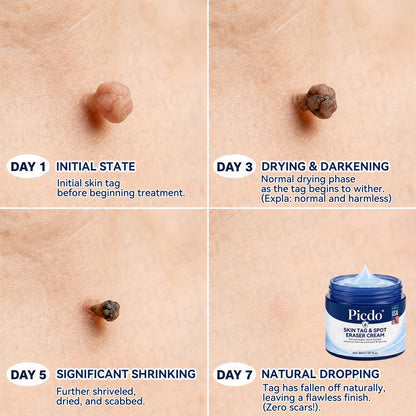 𝐏𝐢𝐜𝐝𝐨® 7-𝐃𝐚𝐲 𝐒𝐤𝐢𝐧 𝐓𝐚𝐠 & 𝐒𝐩𝐨𝐭 𝐄𝐫𝐚𝐬𝐞𝐫 𝐂𝐫𝐞𝐚𝐦 (Zero Pain, Zero 𝐒𝐜𝐚𝐫𝐬 Formula) 🌺