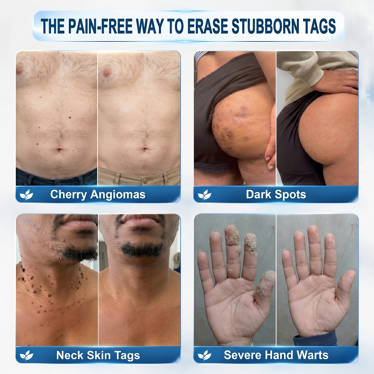 𝐏i𝐜𝐝o®👨‍⚕️ 7-𝐷𝑎𝑦 𝗧𝐚𝐠 & 𝗦𝗽𝐨𝐭 𝐄𝐫𝒂𝒔𝒆𝒓(Zero Pain, Zero 𝐒𝐜𝐚𝒓𝒔 Rollerball)🎉