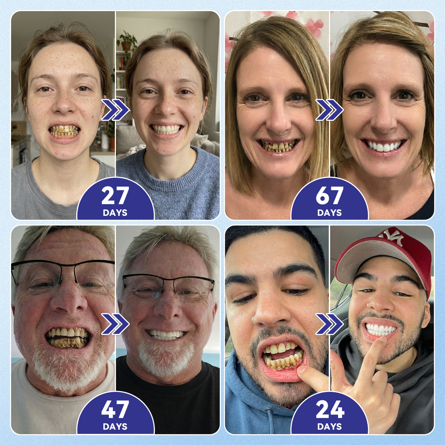 ⏰ Last slot remaining! ⚡ Get 30% OFF — limited time only!🦷𝐆𝐥𝐢𝐦𝐦𝐞𝐫𝐥𝐲® 𝐓𝐢𝐝𝐞𝐠𝐥𝐮𝐬𝐢𝐛 𝐓𝐨𝐨𝐭𝐡 & 𝐆𝐮𝐦 𝐑𝐞𝐩𝐚𝐢𝐫 𝐌𝐢𝐜𝐫𝐨𝐧𝐞𝐞𝐝𝐥𝐞 𝐏𝐚𝐭𝐜𝐡