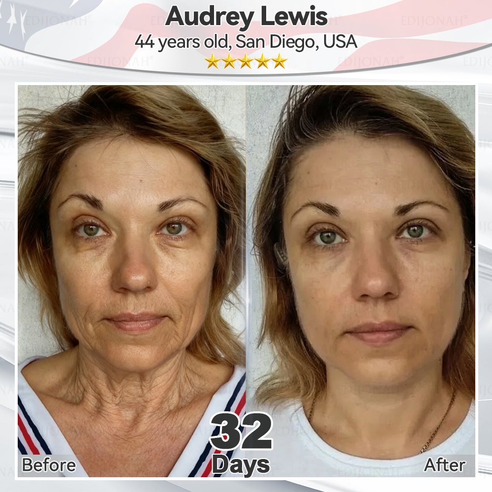 🌿𝐸𝐷𝐼𝐽𝑂𝑁𝐴𝐻®  🎯🎯𝑆𝑡𝑒𝑚 𝐶𝑒𝑙𝑙 𝐸𝑥𝑜𝑠𝑜𝑚𝑒 𝑆𝑒𝑟𝑢𝑚 -（ Anti-aging, reduces wrinkles, improves firmness, enhances radiance, provides deep hydration）
