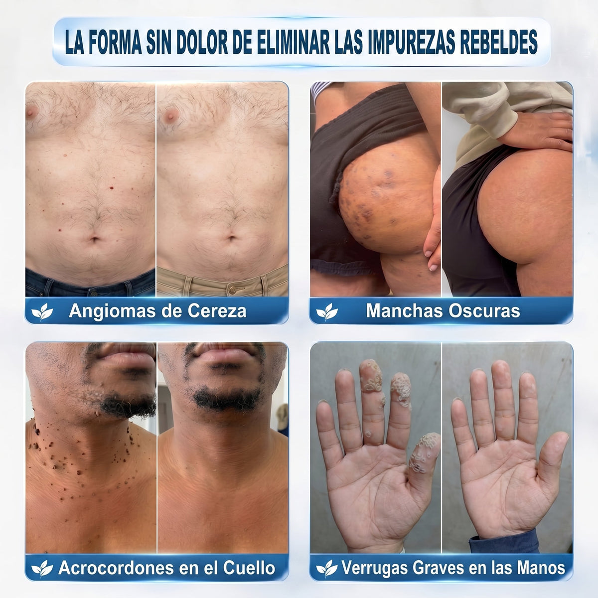 👩‍⚕️🎁𝑻𝒊𝒆𝒏𝒅𝒂 𝑶𝒇𝒊𝒄𝒊𝒂𝒍 | 𝖓𝖊𝕜𝕚𝕤𝕤®🌿 𝑀𝑖𝑐𝑟𝑜𝑎𝑔𝑢𝑗𝑎𝑠 𝑃𝑖𝑒𝑙 𝐼𝑚𝑝𝑒𝑐𝑎𝑏𝑙𝑒 𝐸𝑙𝑖𝑚𝑖𝑛𝑎𝑐𝑖ó𝑛 𝐷𝑒 𝑉𝑒𝑟𝑟𝑢𝑔𝑎𝑠 𝑃𝑎𝑟𝑐ℎ𝑒 (𝑃𝑎𝑟𝑎 𝑎𝑐𝑟𝑜𝑐𝑜𝑟𝑑𝑜𝑛𝑒𝑠, 𝑝𝑒𝑞𝑢𝑒ñ𝑎𝑠 𝑖𝑚𝑝𝑒𝑟𝑓𝑒𝑐𝑐𝑖𝑜𝑛𝑒𝑠 𝑐𝑢𝑡á𝑛𝑒𝑎𝑠, 𝑣𝑒𝑟𝑟𝑢𝑔𝑎𝑠, 𝑙𝑢𝑛𝑎𝑟𝑒𝑠, 𝑚𝑎𝑛𝑐ℎ𝑎𝑠 𝑑𝑒 𝑙𝑎 𝑒𝑑𝑎𝑑 𝑦 𝑝𝑟𝑜𝑏𝑙𝑒𝑚𝑎𝑠 𝑑𝑒 𝑝𝑖𝑔𝑚𝑒𝑛𝑡𝑎𝑐𝑖ó𝑛.)