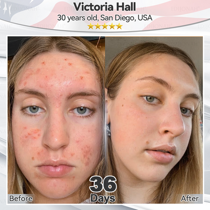 🌿𝐸𝐷𝐼𝐽𝑂𝑁𝐴𝐻®  🎯🎯𝑆𝑡𝑒𝑚 𝐶𝑒𝑙𝑙 𝐸𝑥𝑜𝑠𝑜𝑚𝑒 𝑆𝑒𝑟𝑢𝑚 -（ Anti-aging, reduces wrinkles, improves firmness, enhances radiance, provides deep hydration）