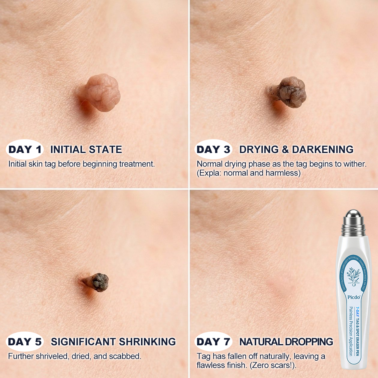 𝐏i𝐜𝐝o®👨‍⚕️ 7-𝐷𝑎𝑦 𝗧𝐚𝐠 & 𝗦𝗽𝐨𝐭 𝐄𝐫𝒂𝒔𝒆𝒓(Zero Pain, Zero 𝐒𝐜𝐚𝒓𝒔 Rollerball)🌟