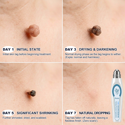 𝐏i𝐜𝐝o®👨‍⚕️ 7-𝐷𝑎𝑦 𝗧𝐚𝐠 & 𝗦𝗽𝐨𝐭 𝐄𝐫𝒂𝒔𝒆𝒓(Zero Pain, Zero 𝐒𝐜𝐚𝒓𝒔 Rollerball)🌟
